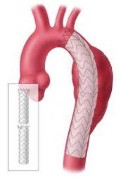 Place Stent Graft Chest Artery